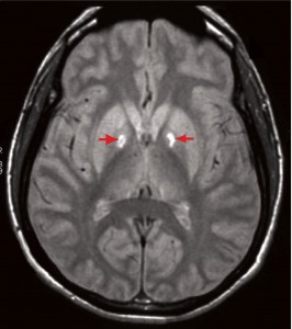 Brain MRI Could Predict Strokes in Asymptomatic Patients